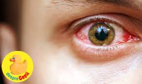 Picaturile oftalmice au multiple indicatii: Ce Afectiuni Indica Ochii Rosii Desprecopii Com