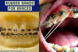 Braces Rubber Bands Purpose Types Colors How To Put Orthodontic Braces Care