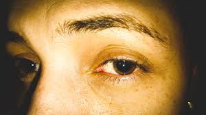 Image result for Mydriasis