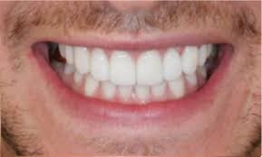 Veneers can also fix minor discrepancies. Veneers For Crooked Teeth Harley Street Smile Clinic