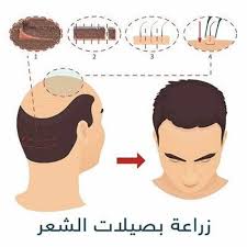 منتدى زراعة الشعر ذكر بعض التجارب المفيدة في عمليات زراعة الشعر حياة Haeat