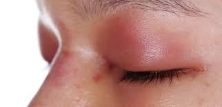 Berhenti menggosok mata menggosok mata dalam keadaan sakit mata sangatlah berbahaya, hal ini. 5 Cara Mengatasi Mata Bengkak Dan Kenali Penyebabnya