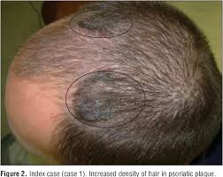 You can likely make a general diagnosis at watch for flaking and bleeding. Plaque Psoriasis Scalp Hair Loss
