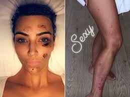 Kim Kardashian om sin psoriasis