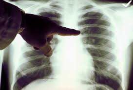 It may have spread to the fluid around your lungs (called the pleura) or other organs like your brain. The Lung Cancer Symptoms Even Nonsmokers Need To Know Cnn