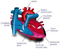 Infarctus du myocarde le figaro santé. Infarctus De La Myocarde Definition Traitement Et Causes