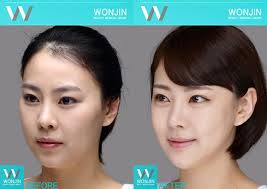 Plastic Surgery In Korea Before And After Photos Wonjin Beauty Wonjinbeauty Wonjinbeautymedicalgroup Plasticsurgery Twojaw Doublejaw