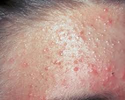 Maybe you would like to learn more about one of these? How To Treat Different Types Of Acne