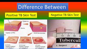 Ppd skin test interpretation based on cdc guidelines. Difference Between Positive Tb Skin Test And Negative Tb Skin Test Youtube