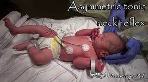 Physical Exam 35 Weeks Gestation Late Preterm Infant Youtube