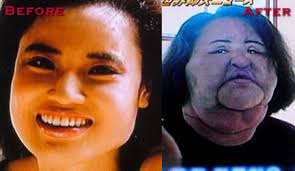 bad plastic surgery before and after ile ilgili görsel sonucu