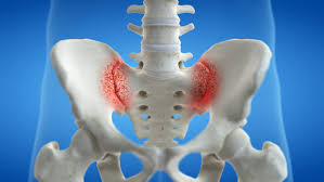Image result for Sacroiliac Dysfunction