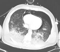 Image result for Pulmonary Contusion