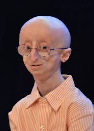 Teen-ager Sam Berns Dies of Old Age