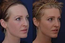 Pin By Katey Drawe On Hair Forehead Reduction Hair Big Forehead Big Forehead