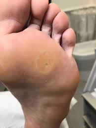 Add 4 tablespoons of epsom salt to your hand or foot bath and soak them for 20 minutes. All About Corns And Calluses Beauchamp Foot Care Beauchamp Foot Care