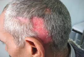 Many hair loss diagnoses do not require a scalp biopsy but rather a careful review of the patient's history and careful examination of the scalp via dermoscopy. Scalp Biopsy And Diagnosis Of Common Hair Loss Problems Intechopen