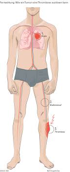 Symptome dieser thrombose sind, dass das betroffene gewebe kalt und blass wirkt. Krebsalarm Im Bein Nzz