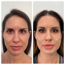 Things to do before thread lift treatment. Medithread Pdo Thread Lifts At Uglow Aesthetics Fabulous Arizona