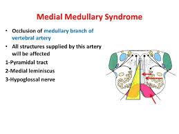 Image Result For Dorsolateral And Medial Medulla Vertebral Artery Hypoglossal Nerve Nerve