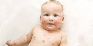Bei der entstehung wirken genetische faktoren (veranlagung), umwelteinflüsse, die psyche und mechanische reize komplex zusammen. Baby Neurodermitis Was Eltern Tun Konnen Herold At