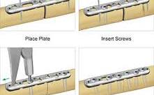 Forearm Plates - Upper Extremity Fracture Fixation - TriMed Inc.