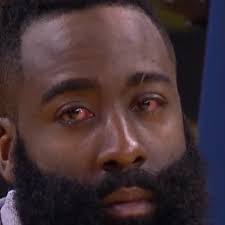 The most obvious presentation of ocular (eye). Houston Rockets Star James Harden S Eye Injury Is The Internet S Favorite New Meme Deseret News