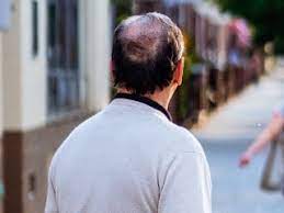 When the body does not get all the vitamins or supplements it needs, imbalances tend to happen which in turn causes things like hair fall. Suffering From Hair Loss Or Baldness New Study May Have Solution For You Technology News
