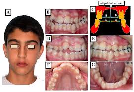 The Complexity of Skeletal Transverse Dimension: From Diagnosis,  Management, and Treatment Strategies to the Application of Collaborative  Cross (CC) Mouse Model