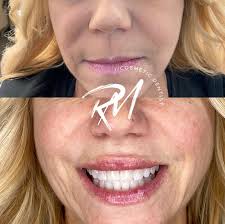 LIP INJECTIONS!! This self-proclaimed “soccer mom” felt that her lips were  the only thing aging her face. She requested a “natural” looking, fuller  upper lip to create balance to her smile (can