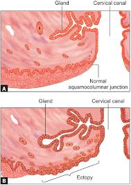 Image result for Friable Cervix