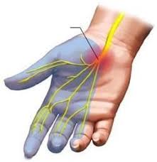Carpal Tunnel Syndrome Irvine Ca Surgery Of The Hand Wrist Christopher G Katcherian Md
