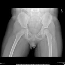 Representative images of normal pelvic anatomy, with select videos. Normal Pelvis X Ray 4 Year Old Radiology Case Radiopaedia Org