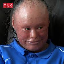 Dr. Lee starts the work of removing Roger's ENORMOUS Rhinophyma