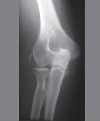 Red dot indicates position of radial tuberosity which moves from Radiograph Of The Elbow Showing Calcification Of The Lateral Epicondyle Download Scientific Diagram
