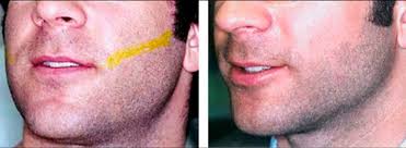 Right after a tanning session, your skin remains highly sensitive (up to 2 weeks at least). Mens Laser Hair Removal Results