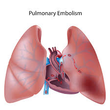 Doctors use a variety of tests to detect blood clots and/or rule out other causes. Pulmonary Embolism Pe Blood Clot In The Lung Doctor Rennie S Blog