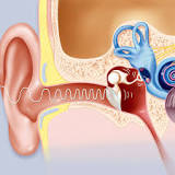 Image result for how does a ventilation tube function in the treatment of otitis media