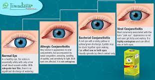 Bacterial Viral Allergic Are Forms Of Conjunctivitis They Cause Inflammation Of The Transparent And M Pink Eyes Conjunctivitis Bacterial Conjunctivitis