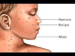 खसर Measles क क रण लक षण और उसस बच व क ल ए घर ल उपच र Youtube