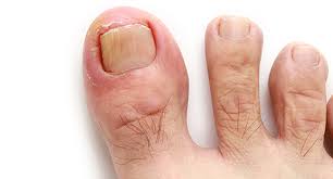If you can pinpoint how you contracted your fungal infection, this may allow you to. Toenail Fungus Treatment In New York Podiatrist In Manhattan