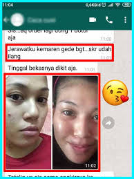 Keunggulan Acnes Sealing Jell Dibanding Lainnya Obat Jerawat