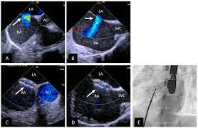 Children | Free Full-Text | Transcatheter Device Therapy and the  Integration of Advanced Imaging in Congenital Heart Disease