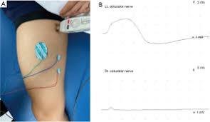 Image result for Obturator Nerve Compression