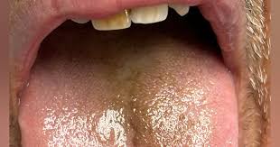Image result for black hairy tongue symptoms