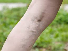 Erasing Spider Veins Drweil Com