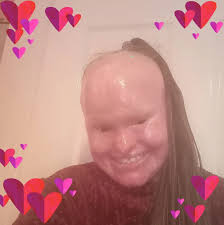 Woman whose skin grew too fast for her body dies aged 32 : The Premier Daily