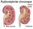 Symptome pyelonephrite