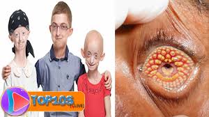 10 Most Weirdest And Rarest Diseases Known To Mankind Top10slive Youtube