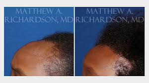 The price of hairline lowering is approximately £7,500. Hairline Lowering Frisco Tx Forehead Reduction Dallas